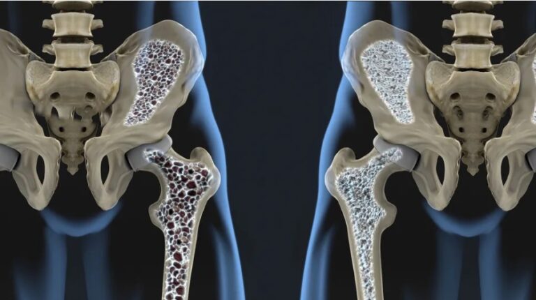 Osteoporosis: Causes, Symptoms, and Prevention